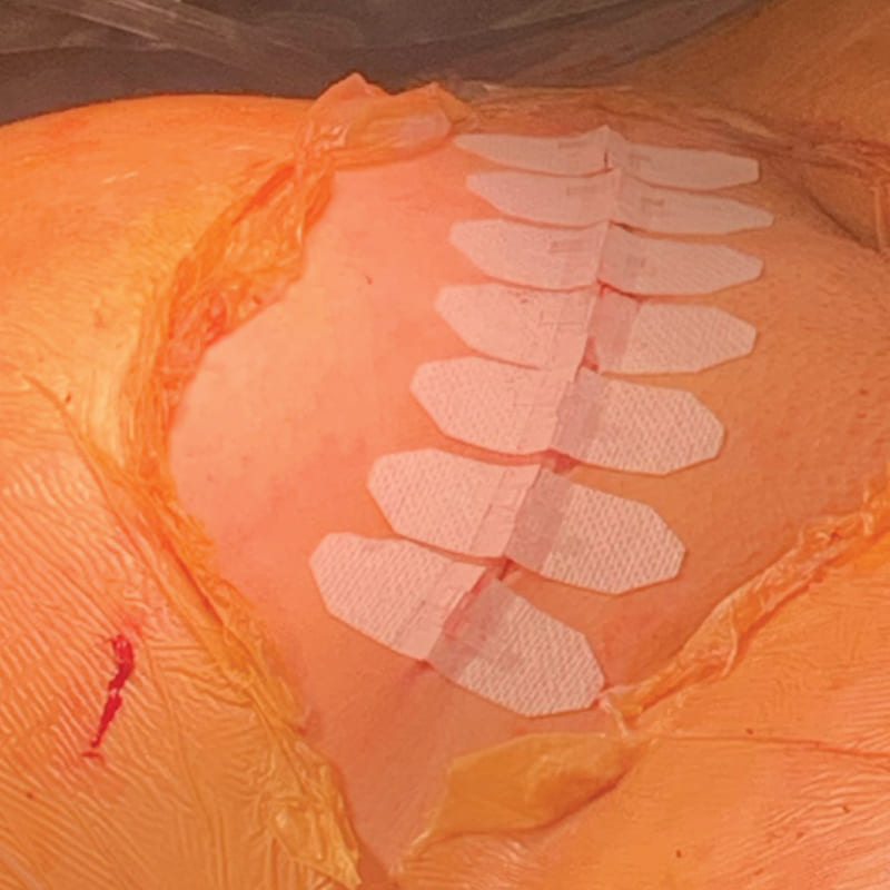 DermaClip for C-Sections