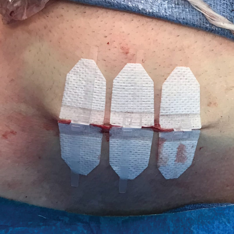 DermaClip for Cardiac Cath Labs
