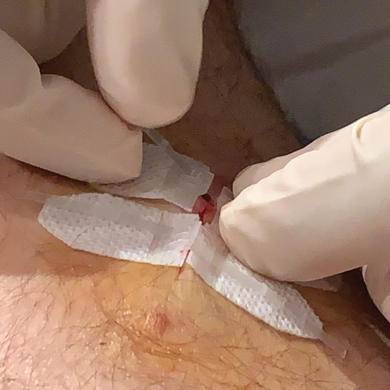 DermaClip for Dermatology Mohs