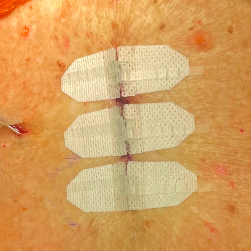 DermaClip for Laminectomy