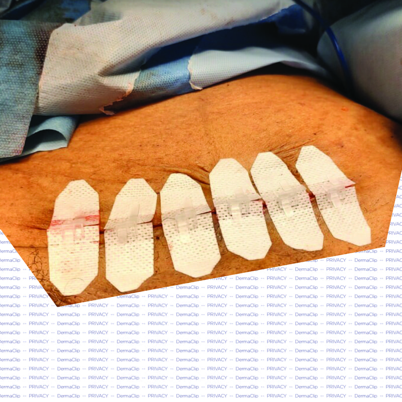 DermaClip for Pfannenstiel Incision