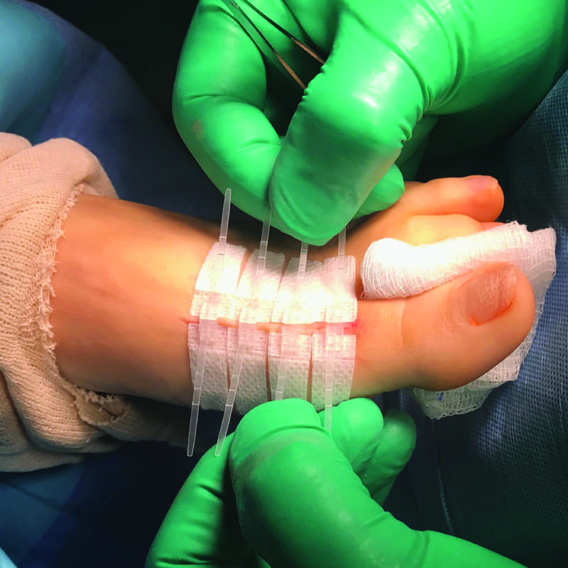 DermaClip for Podiatric Surgery