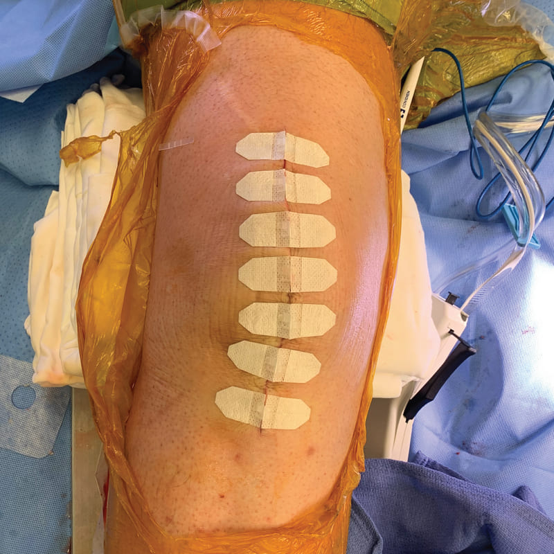 DermaClip for Total Knee Arthroplasty