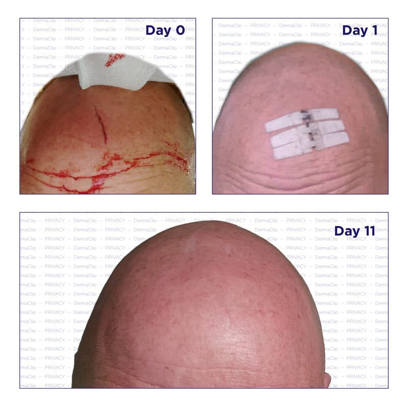 DermaClip on Forehead Laceration